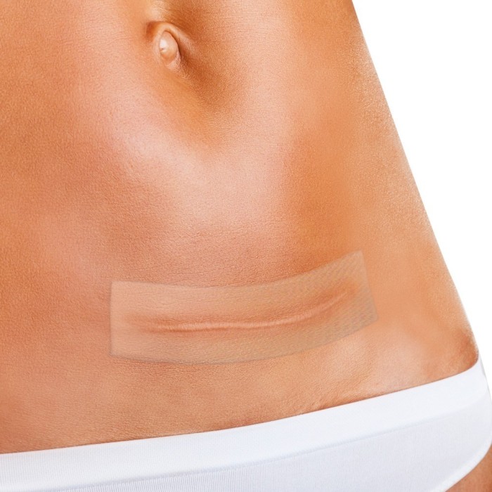 Apósito para tratamiento de cicatrices...