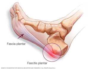 fascia plantar - dolor planta de los pies